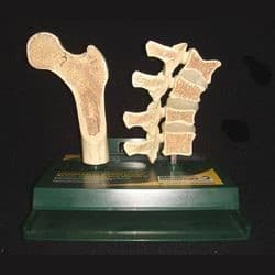 OSTEOPOROSIS DEMONSTRATION MODEL